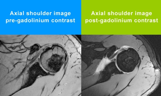 Shoulder MRI Arthrograms